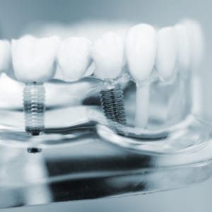 Multiple Dental Implants Hoffman Estates, IL