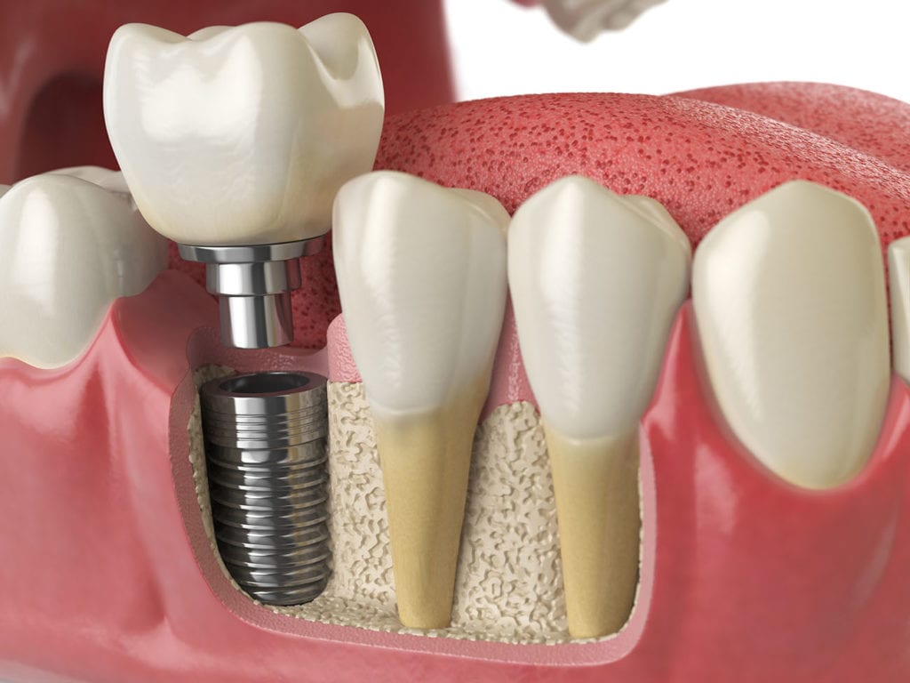 Dental Implant Process Hoffman Estates IL