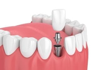 affordable dental implants in hoffman estates, illinois