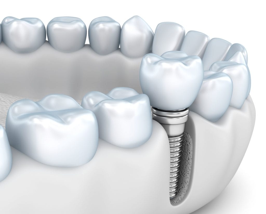 Single Dental Implant Hoffman Estates Illinois