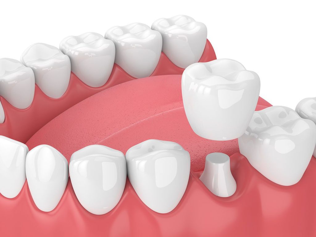 dental crown benefits in Hoffman Estates Illinois
