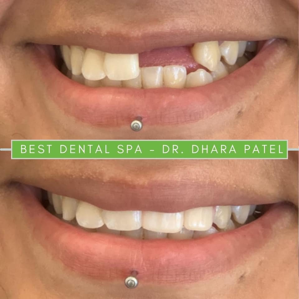 dental implant before and after procedure at Best Dental Spa