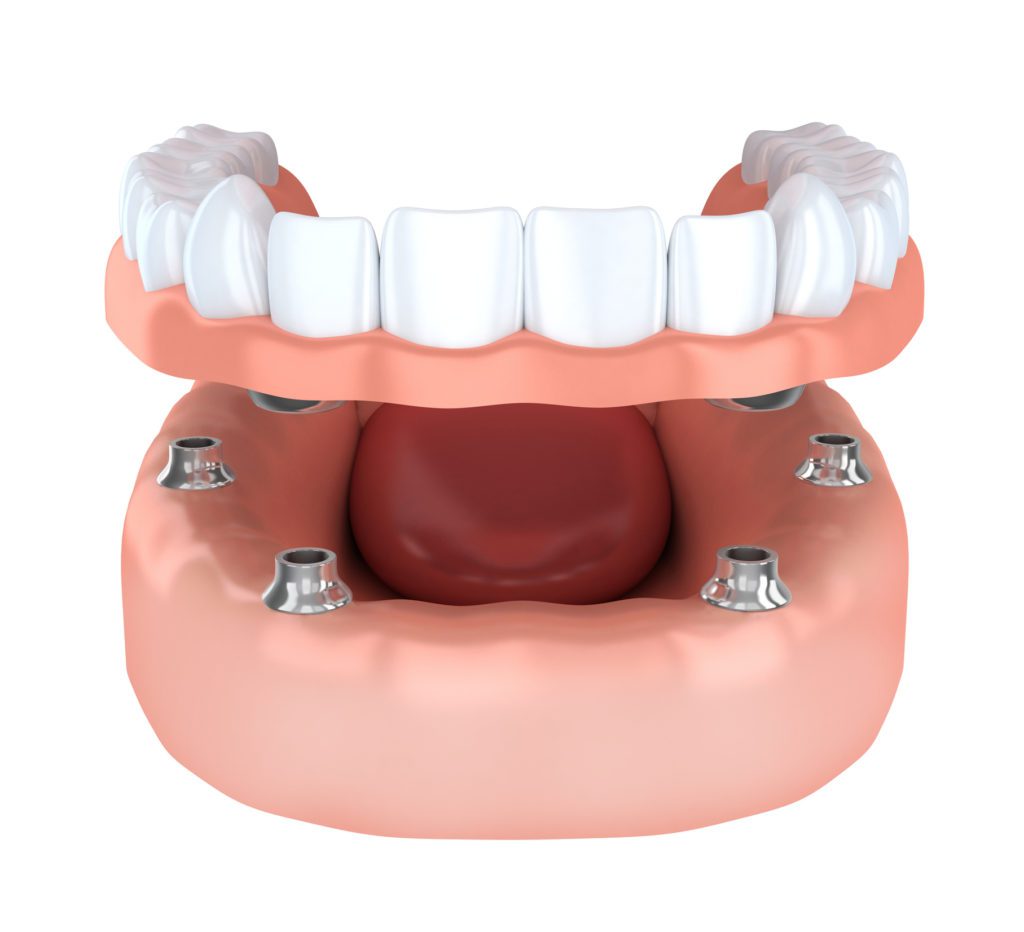 Dental Implants or Dentures? Hoffman Estates, IL