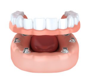 Implant-Secured Dentures in Hoffman Estates, IL